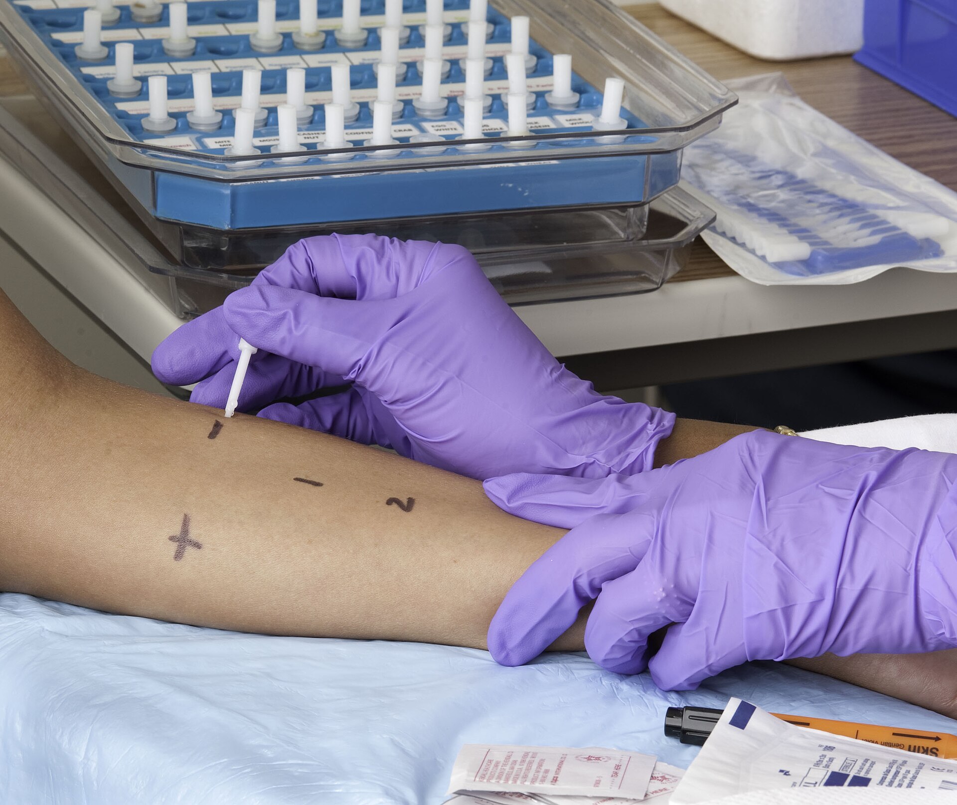A nurse in purple gloves doing a skin prick test on someone's forearm, with a tray of labelled test drops on the bench behind