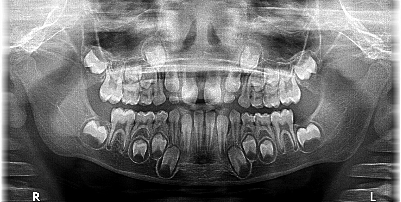A panoramic dental X-ray of a child's jaws, showing the milk teeth in place with the larger adult teeth still forming in the bone beneath them