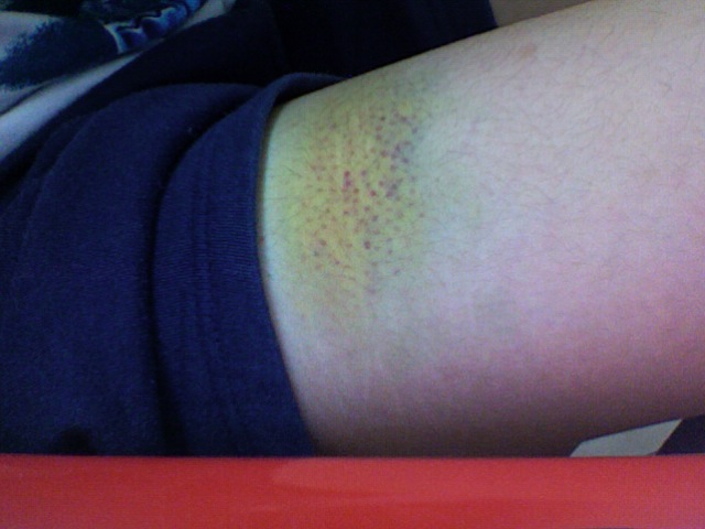 A bruise, blood that has leaked from tiny broken vessels under unbroken skin.