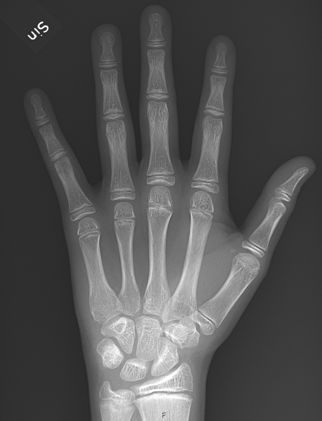 An X-ray of a child's hand, showing small gaps near the ends of the finger bones: the growth plates where new bone is added while you are still growing.