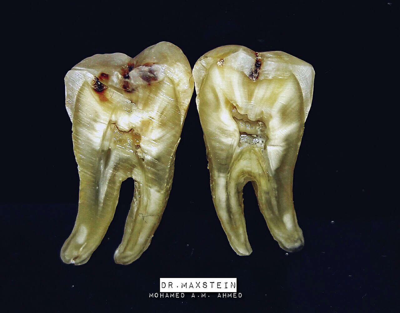 Two halves of a tooth cut lengthways against a black background, showing dark decay eating in from the chewing surface