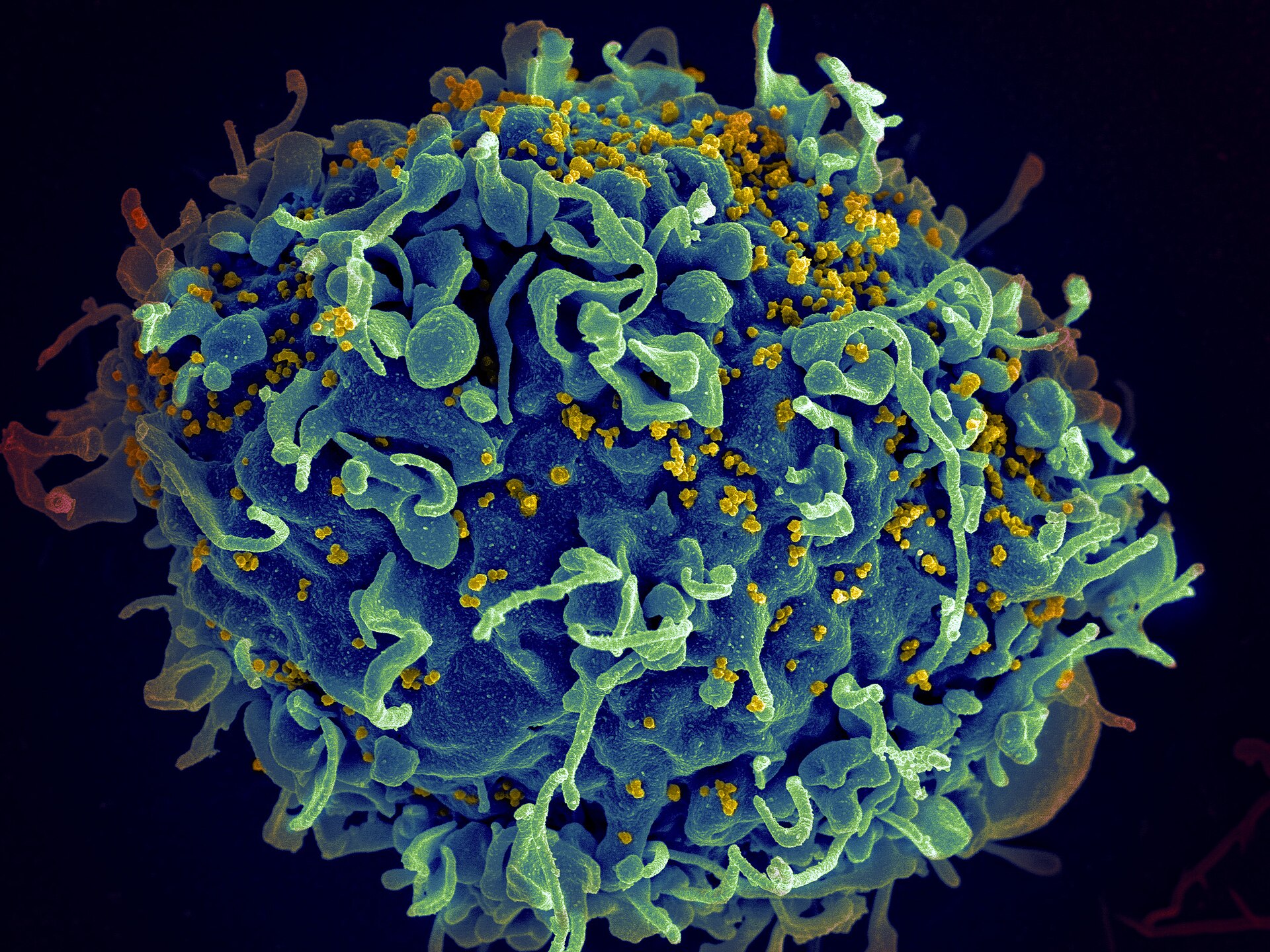 A coloured electron microscope image of a single human cell, blue and green, studded with tiny yellow virus particles.